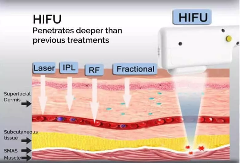 hifu how it works